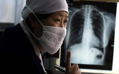 tuberculosis china20170324134548_l